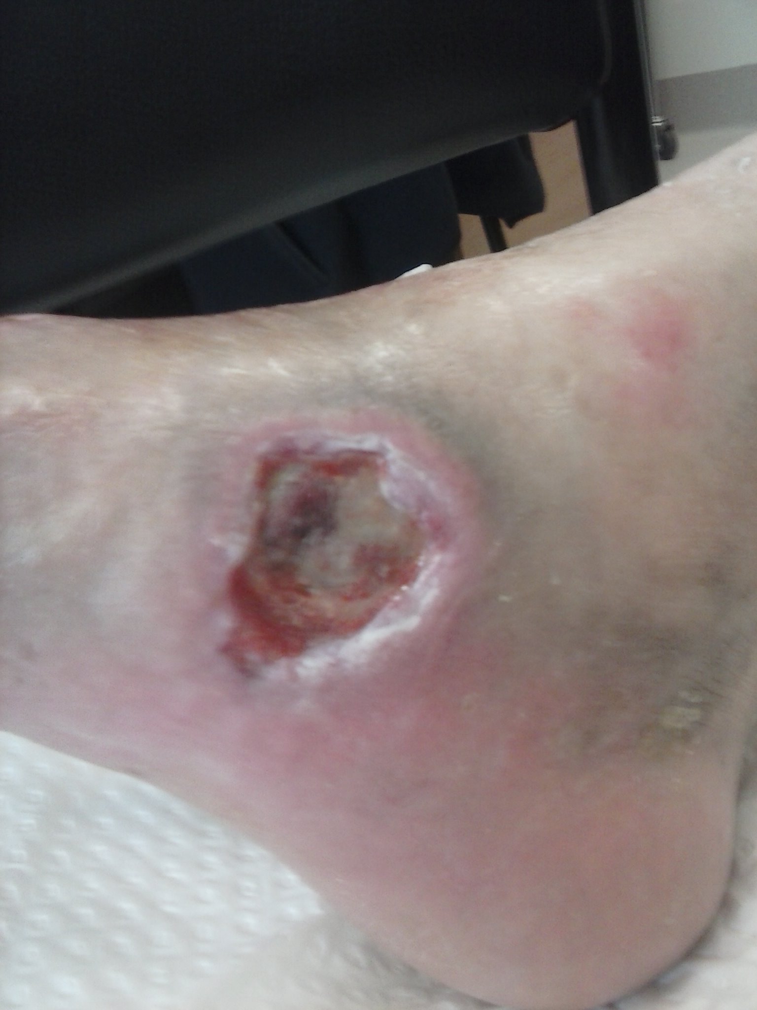 medial ankle 14.11.13.jpg