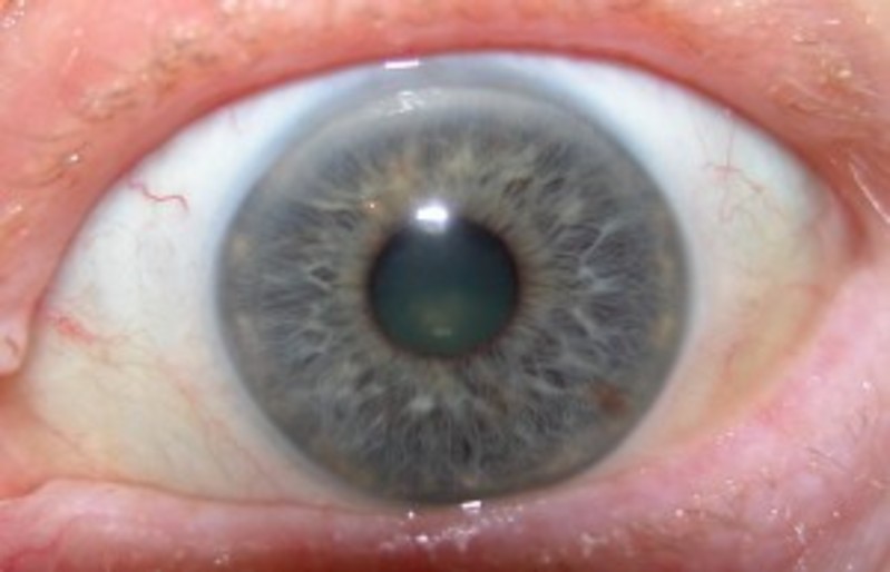 Blue arcus senilis .jpg